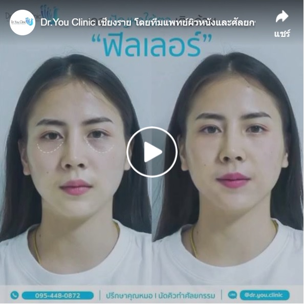 ภาพก่อน-หลังฉีดฟิลเลอร์ใต้ตา ดวงตาดูสดใสขึ้น ร่องใต้ตาหายไป รอยคล้ำลดลง 