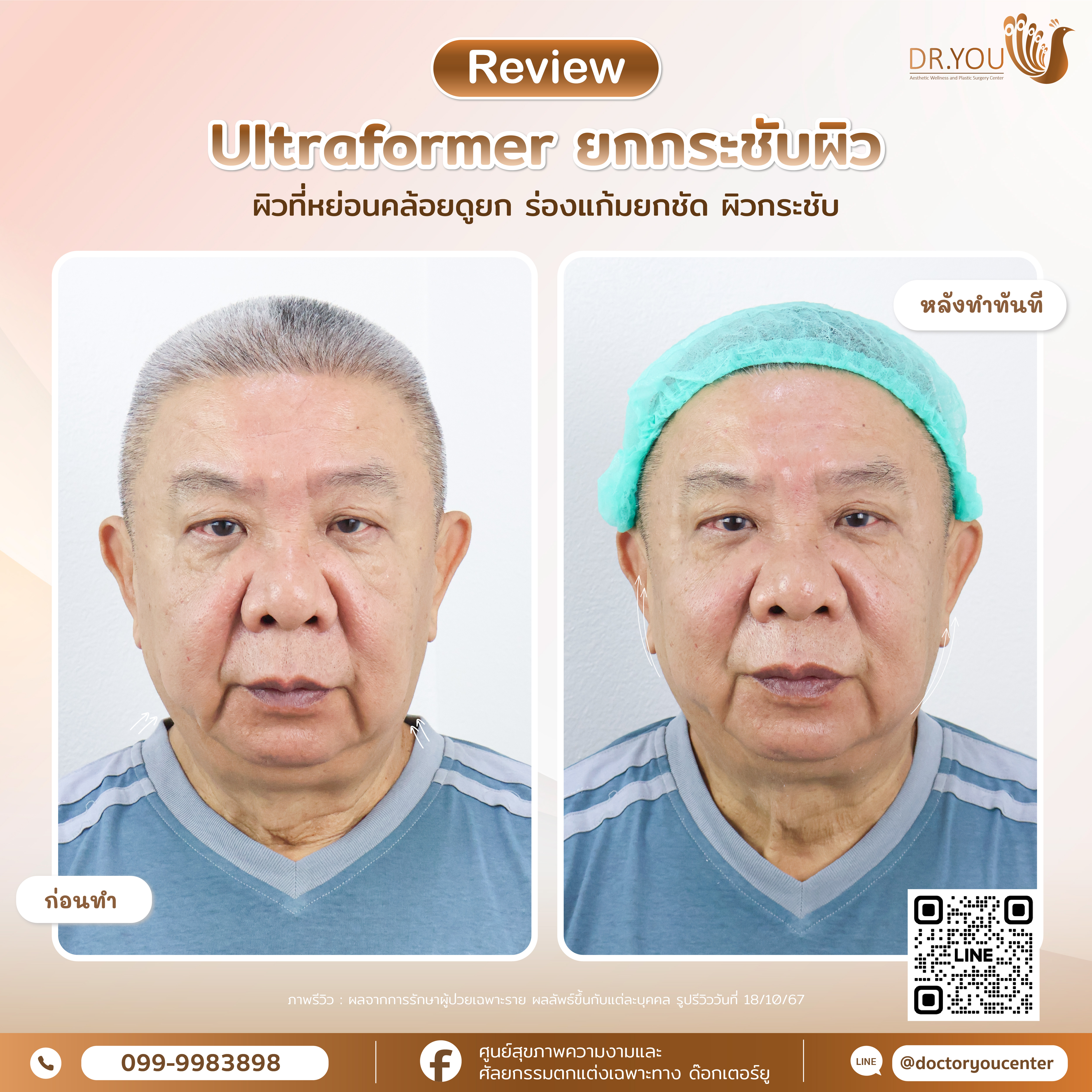รีวิวอัลตร้าฟอร์มเมอร์ ทรี (Ultraformer III)