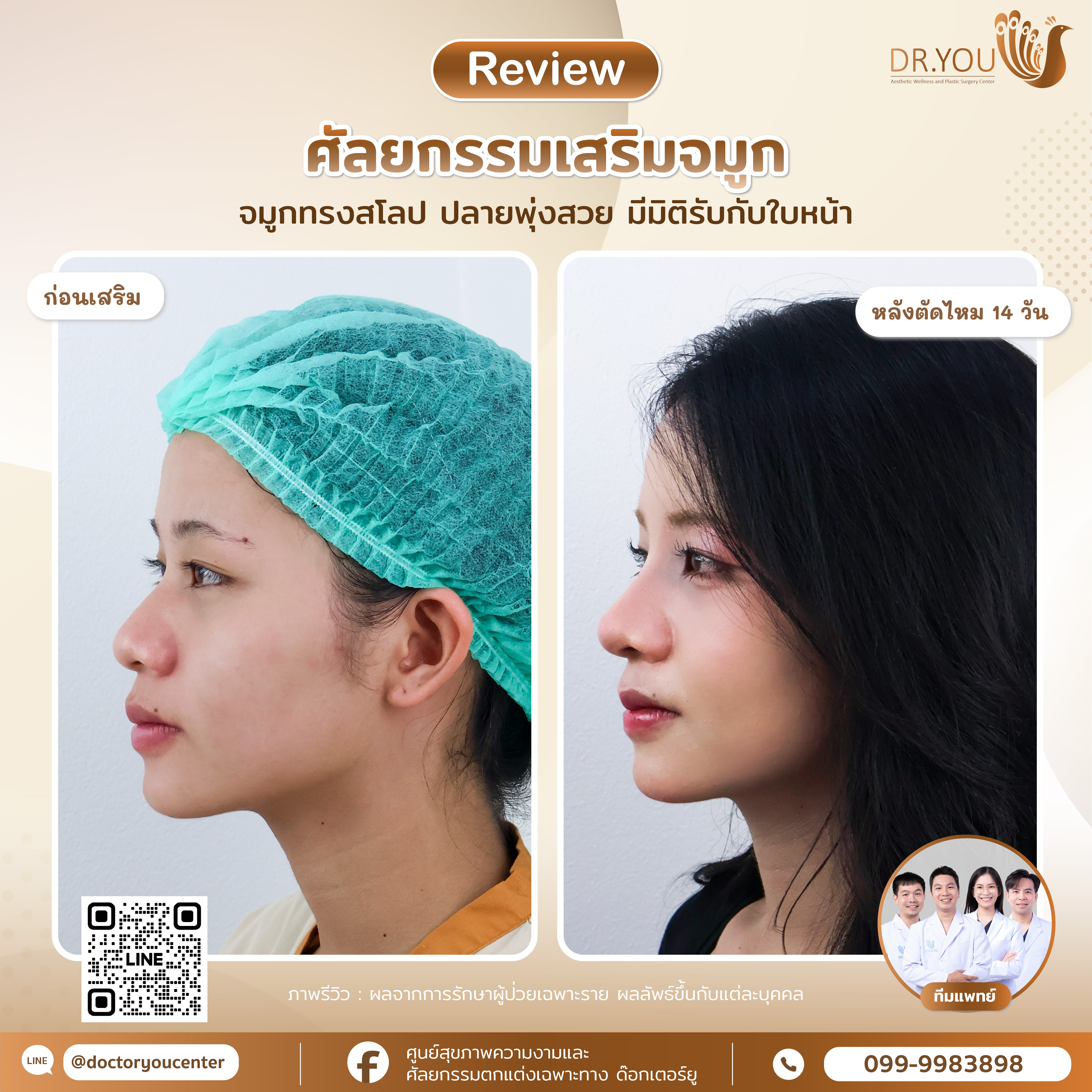 รีวิวเสริมจมูก