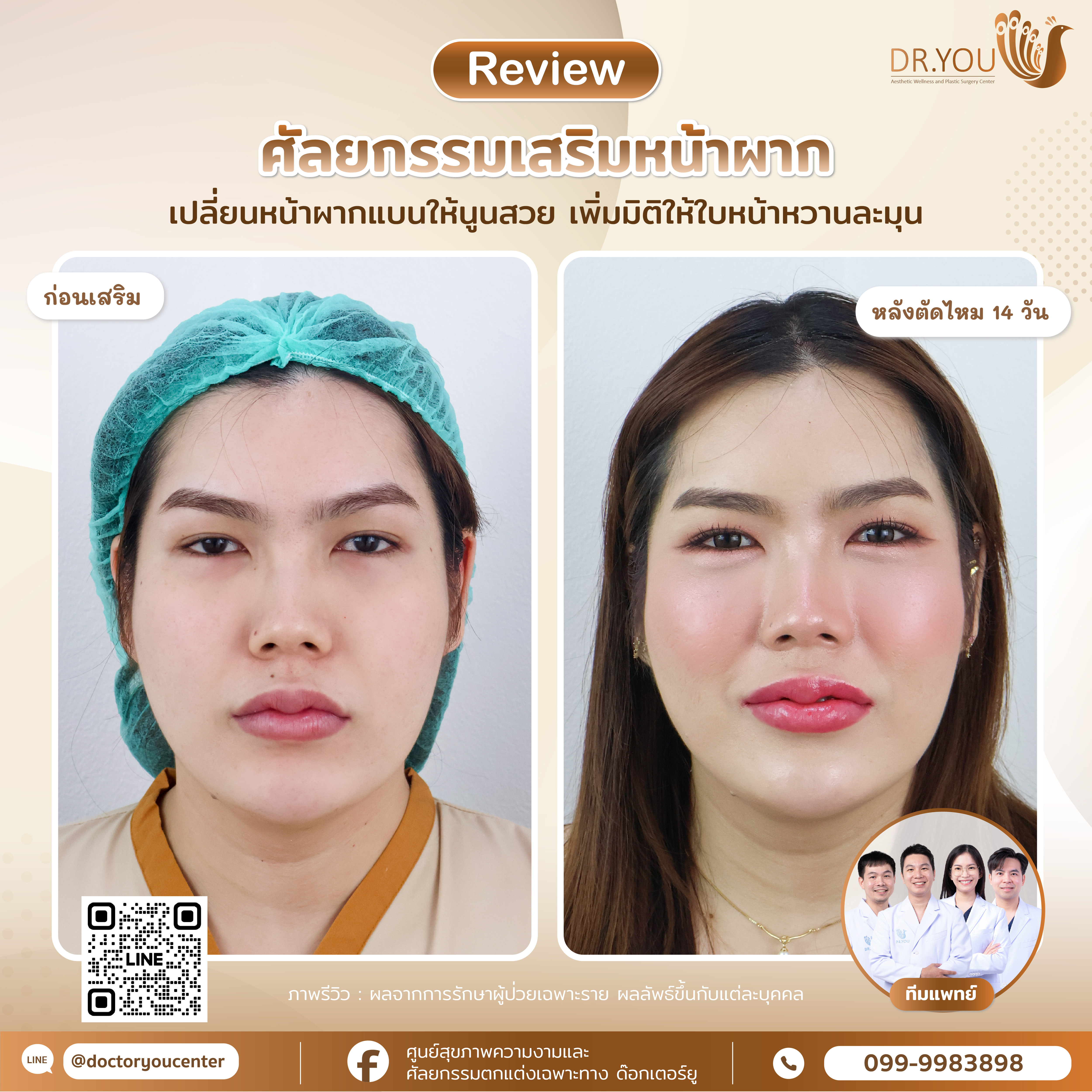 รีวิวเสริมหน้าผาก