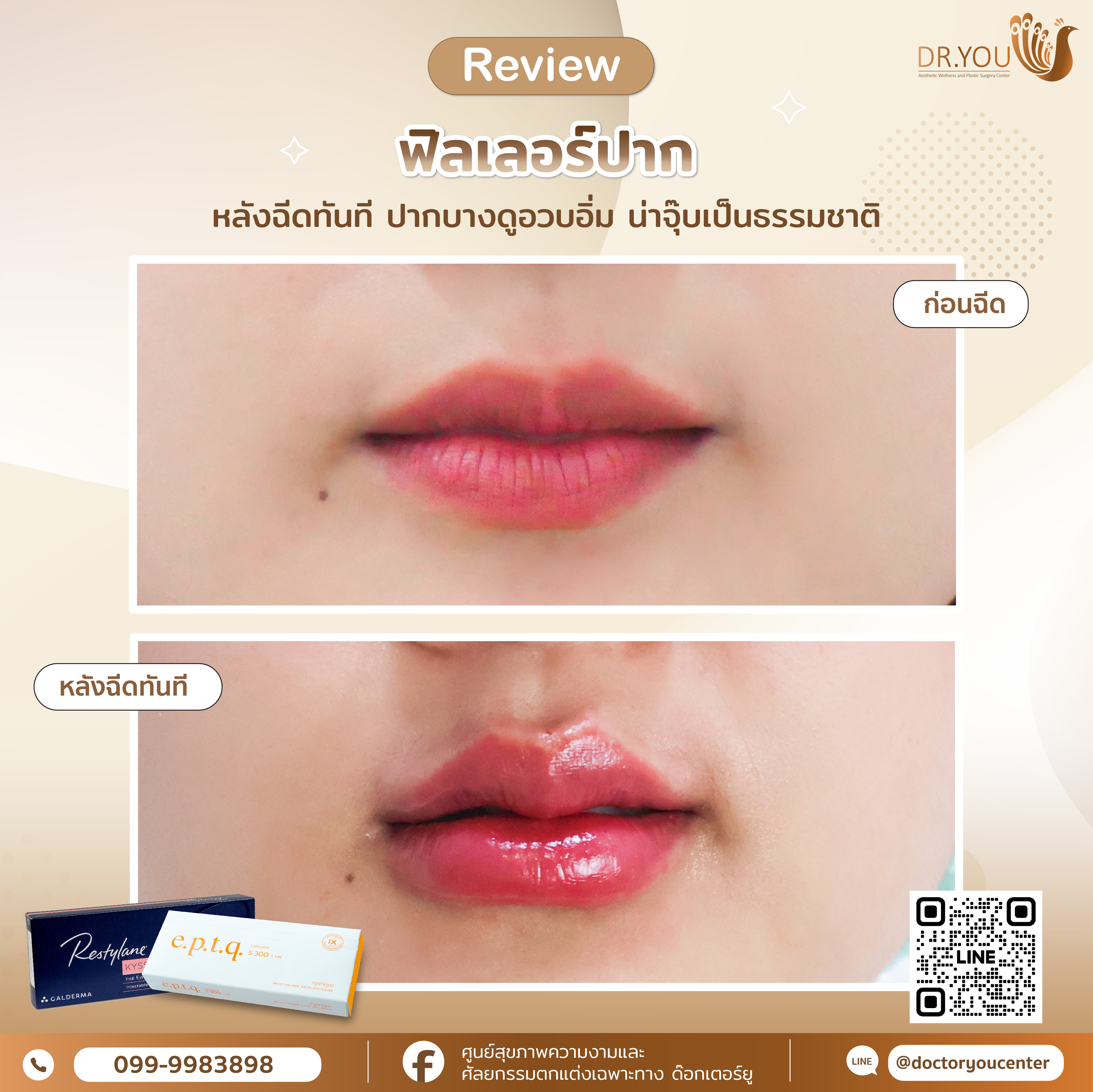 รีวิวฟิลเลอร์ปาก