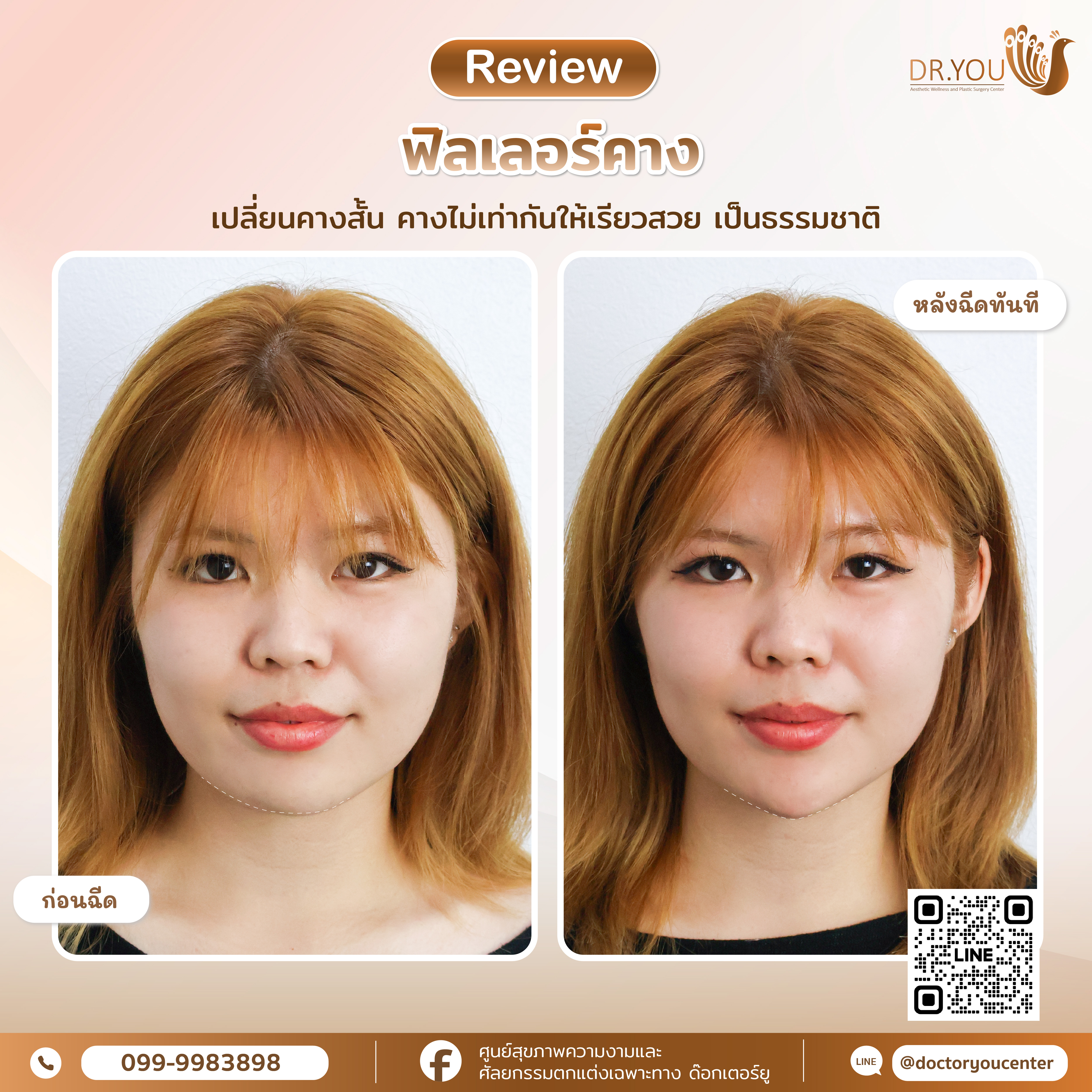 รีวิวฟิลเลอร์คาง