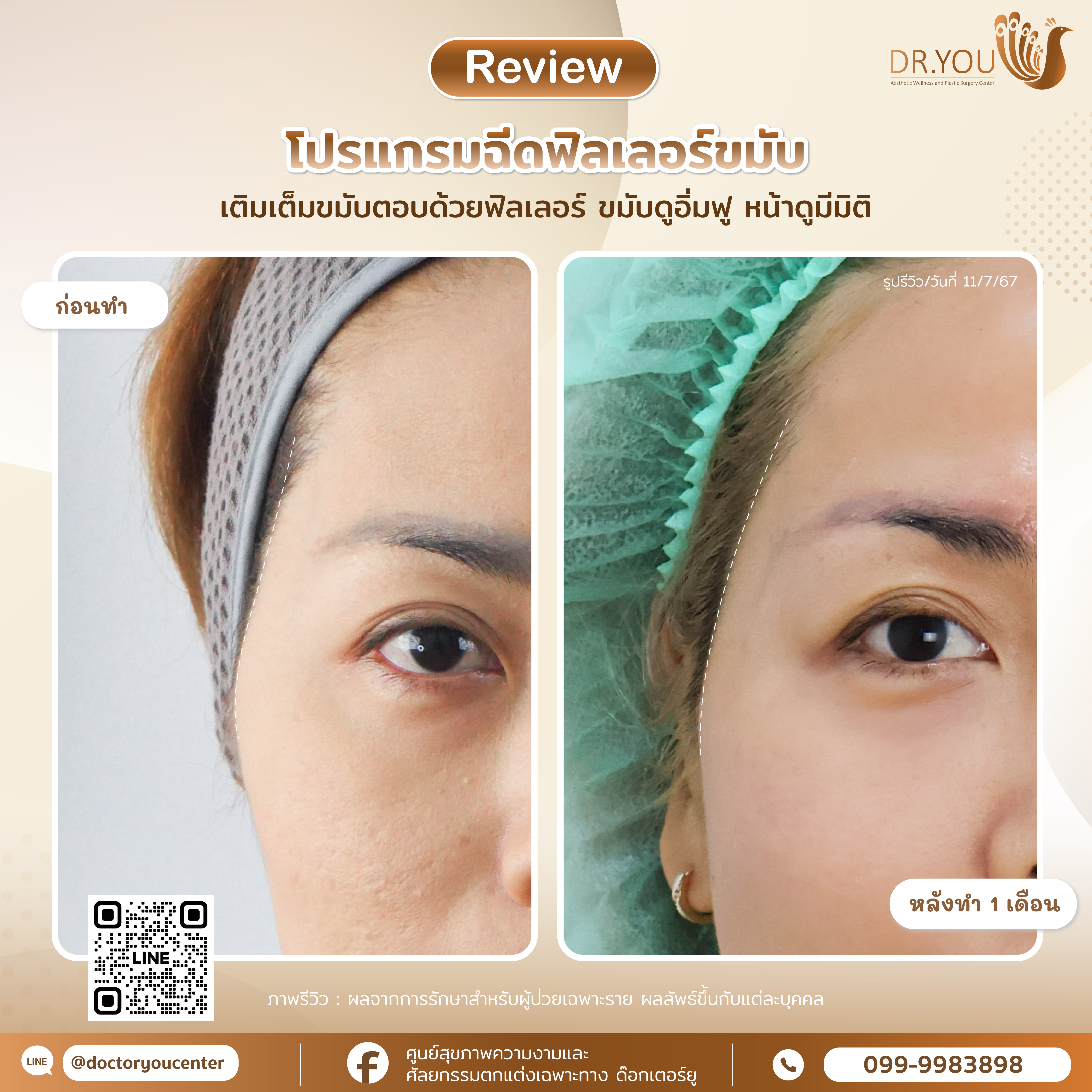 รีวิวฟิลเลอร์ขมับตอบ
