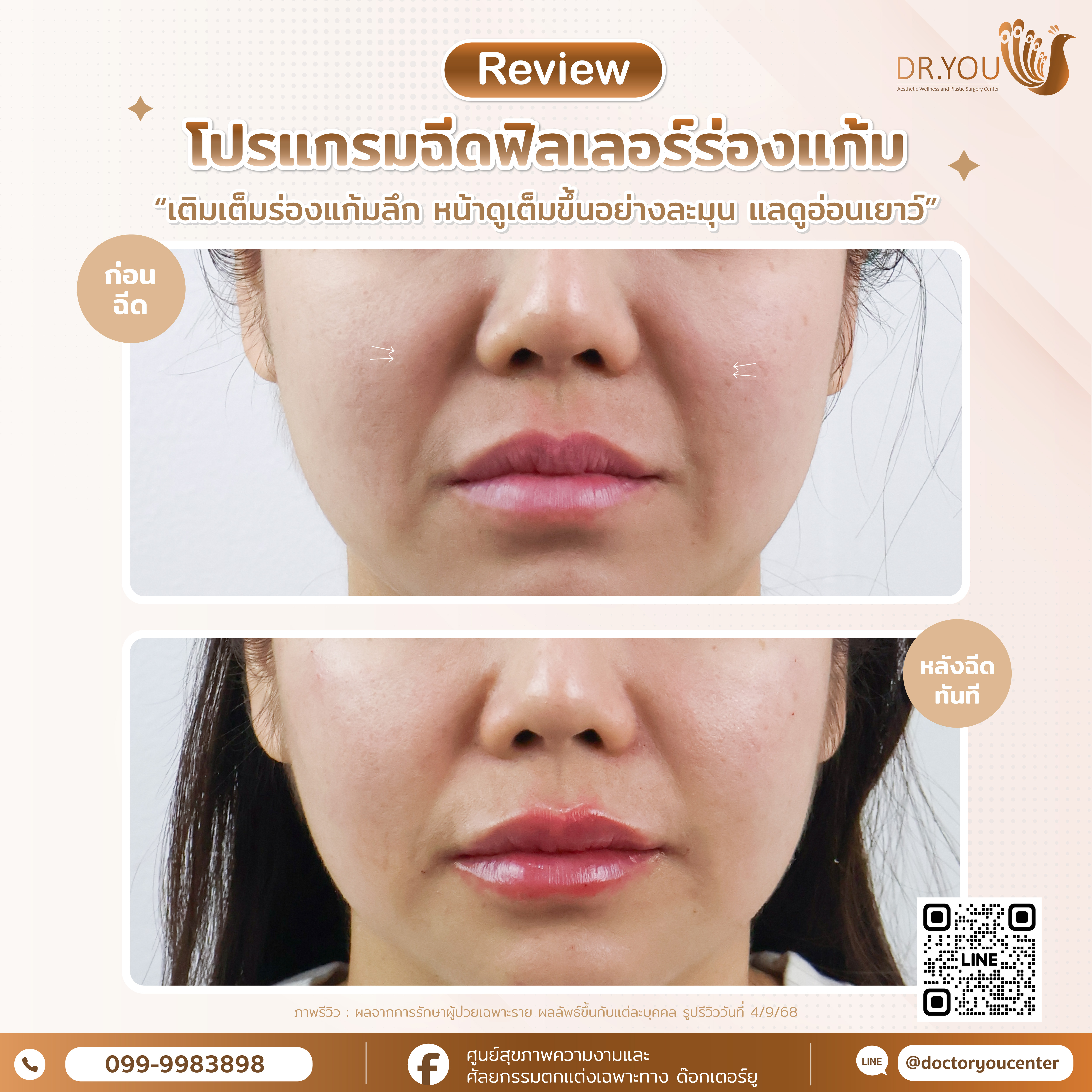 รีวิวฟิลเลอร์ร่องแก้ม+แก้มส้ม+แก้มตอบ