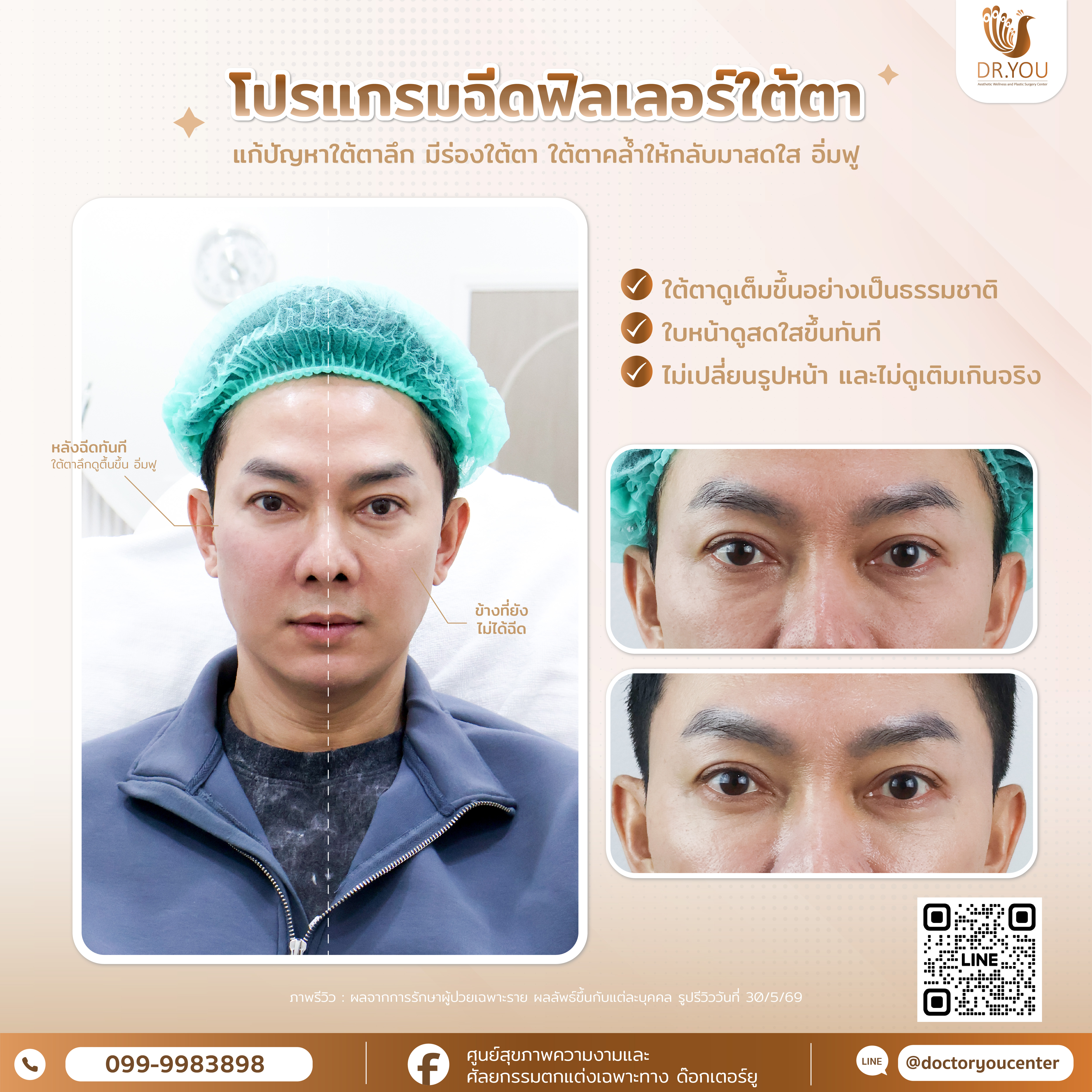 รีวิวฟิลเลอร์ใต้ตา