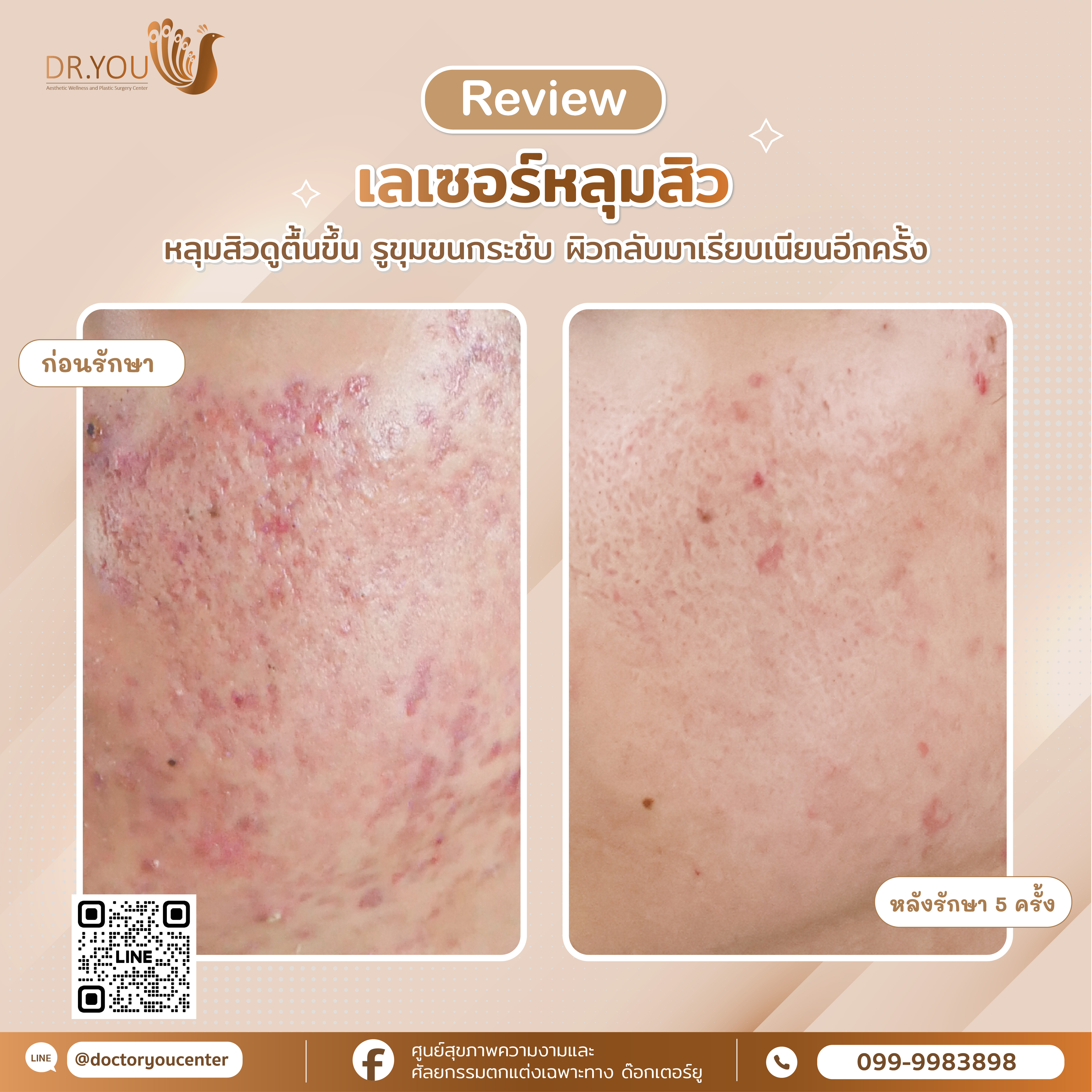 รีวิวหลุมสิว